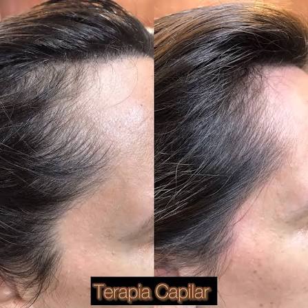 Hair Growth